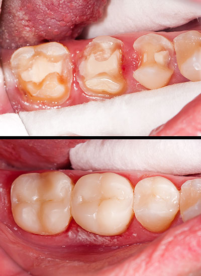 Fasteau Family Dentistry | Dental Fillings, Oral Exams and Crowns  amp  Caps